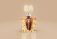 იმპლანტაცია ფასი და ხარისხი – როგორ ავირჩიოთ საუკეთესო კბილის იმპლანტი